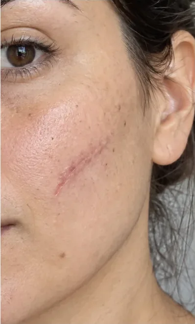 Guancia con una linea rosata visibile prima della prova colore