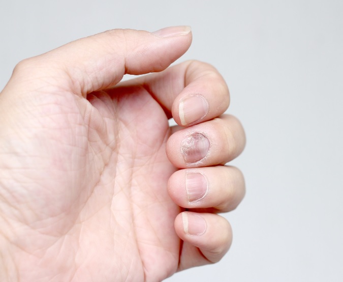 Onychomycosis treatment